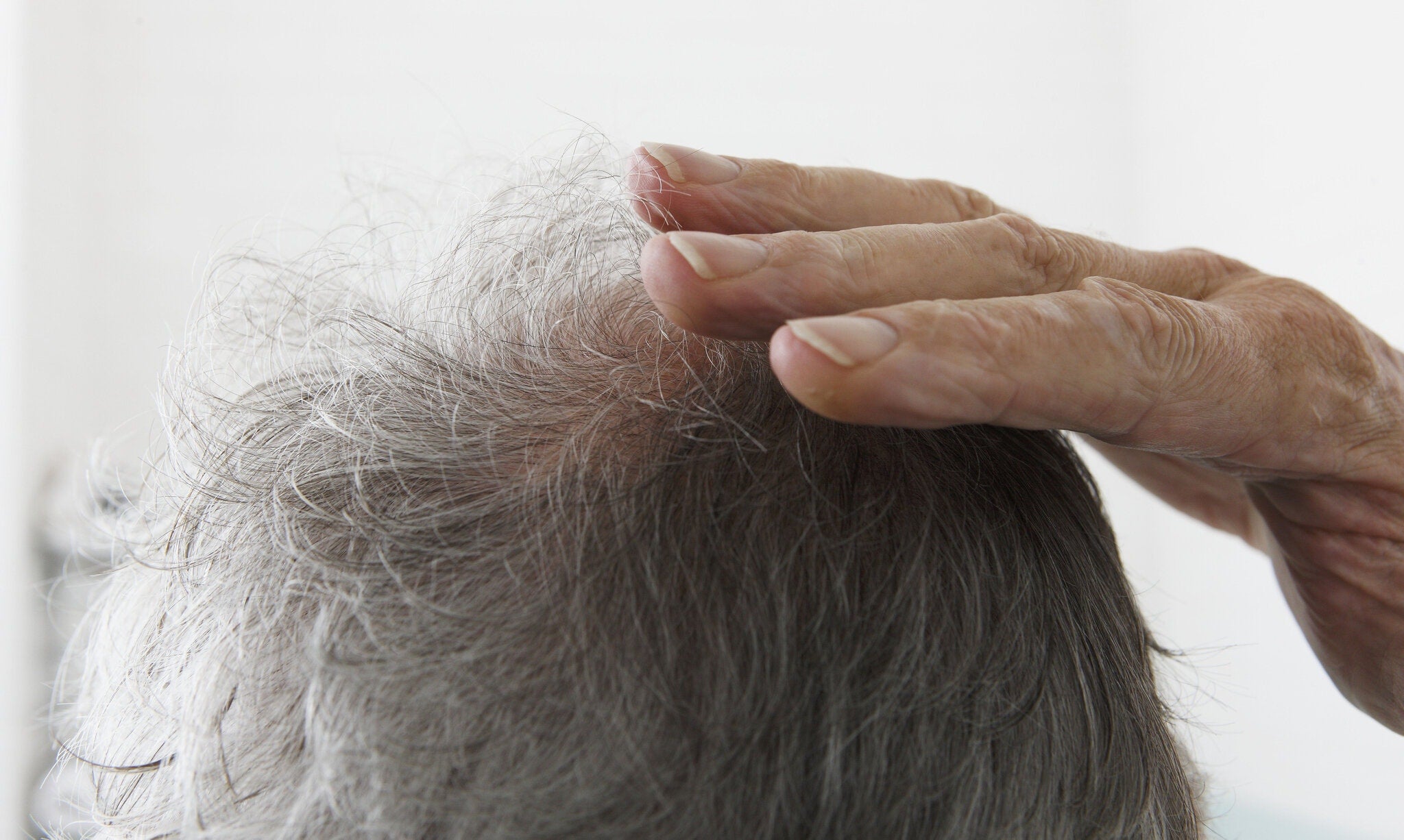 Losing Your Hair? You Might Blame the Great Stem Cell Escape.