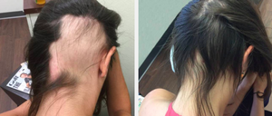 Alopecia... There is a Solution